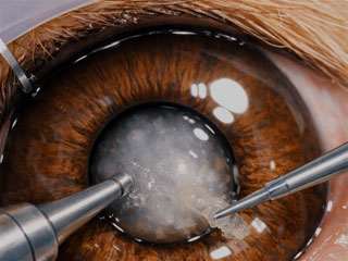 Cirugía de cataratas